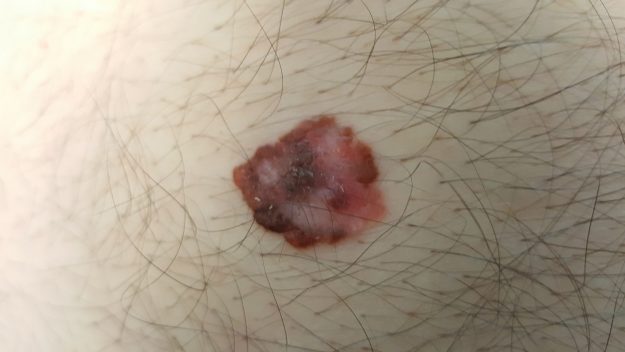 melanoma_1 Melanoma