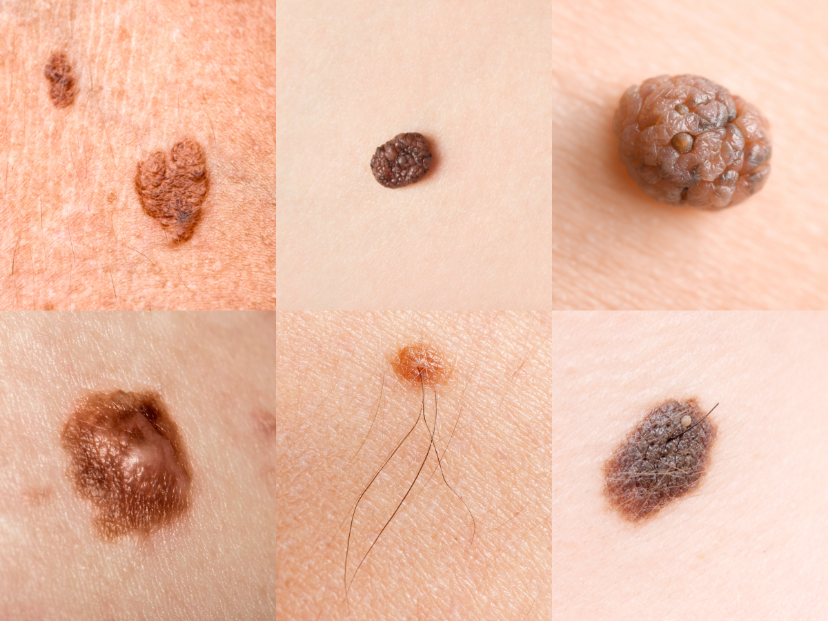 Decoding Skin Cancer: Types, Symptoms, and Risk Factors – The Skin Cancer  Doctor